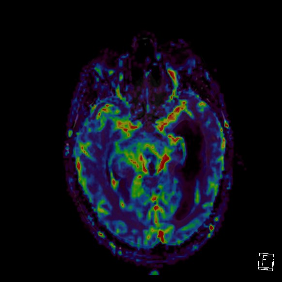 Central neurocytoma (Radiopaedia 84497-99872 Axial Perfusion 192).jpg