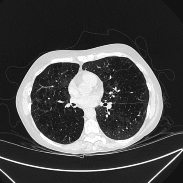 Centrilobular pulmonary emphysema (Radiopaedia 24495-24789 Axial lung window 53).jpg