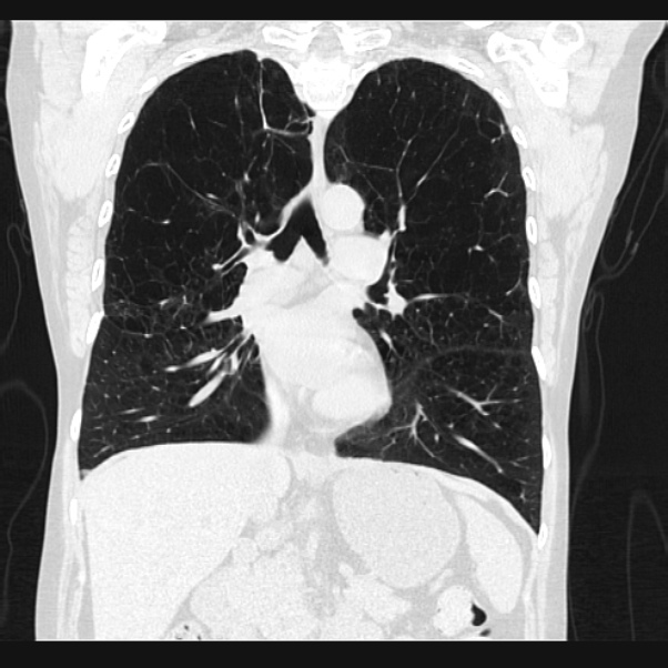 Centrilobular pulmonary emphysema (Radiopaedia 24495-24789 Coronal lung window 38).jpg