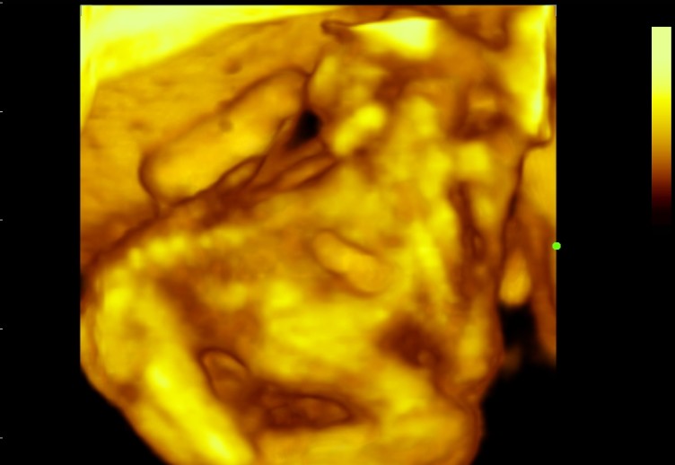 File:Cephalopagus conjoined twin (4D ultrasound) (Radiopaedia 84793-100256 2D Ultrasound 1).jpg