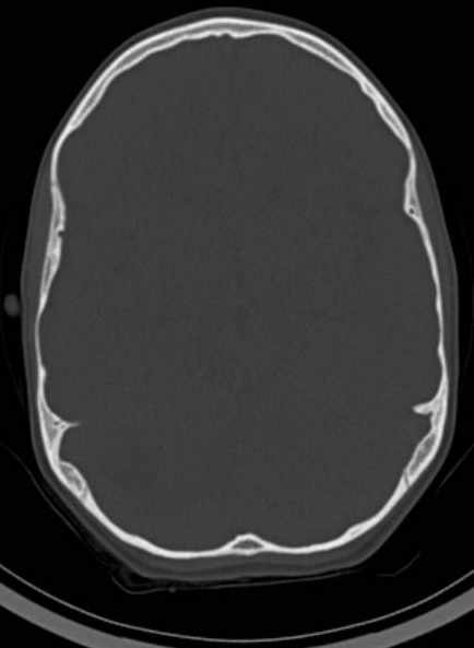 Cerebellar abscess (Radiopaedia 73727-84527 Axial bone window 32).jpg