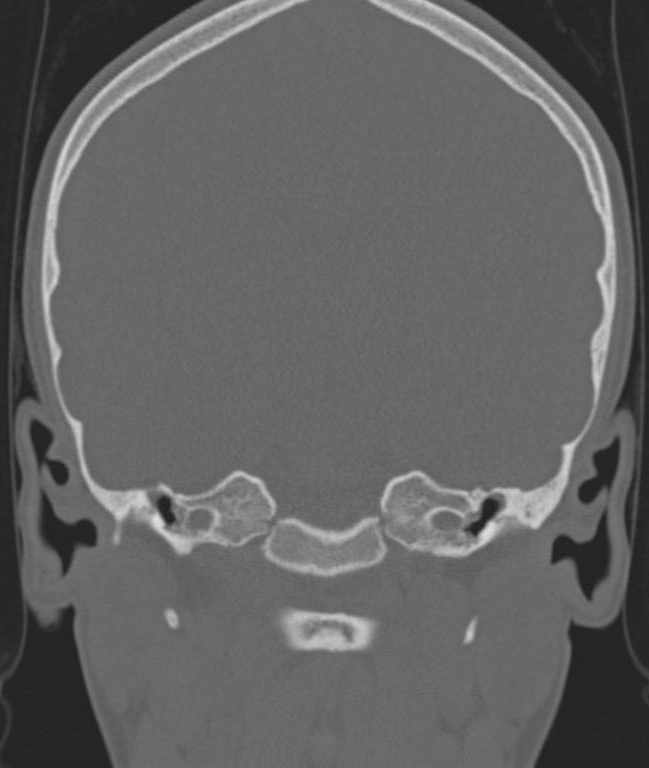 Cerebellar abscess (Radiopaedia 73727-84527 Coronal bone window 76).jpg