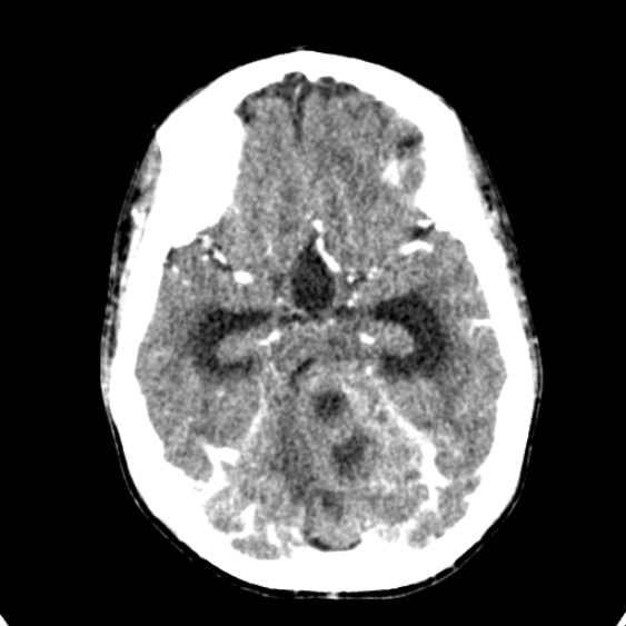 Cerebellar abscess secondary to mastoiditis (Radiopaedia 26284-26412 Axial C+ delayed 55).jpg