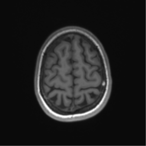 File:Cerebellar agenesis with hypoplastic pons (pontocerebellar hypoplasia) (Radiopaedia 57224-64138 Axial T1 65).png