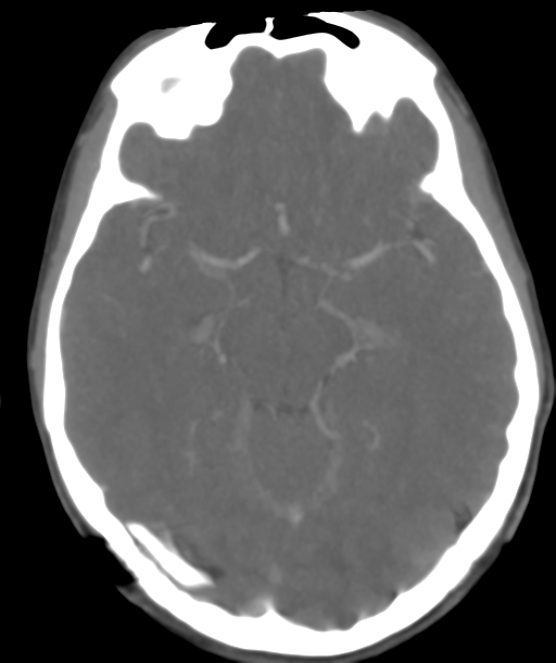 Cerebellar arteriovenous malformation- with hemorrhage (Radiopaedia 35752-37297 B 22).png