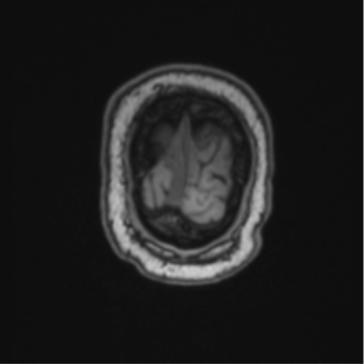 File:Cerebellar hemangioblastomas and pituitary adenoma (Radiopaedia 85490-101176 Coronal T1 11).png