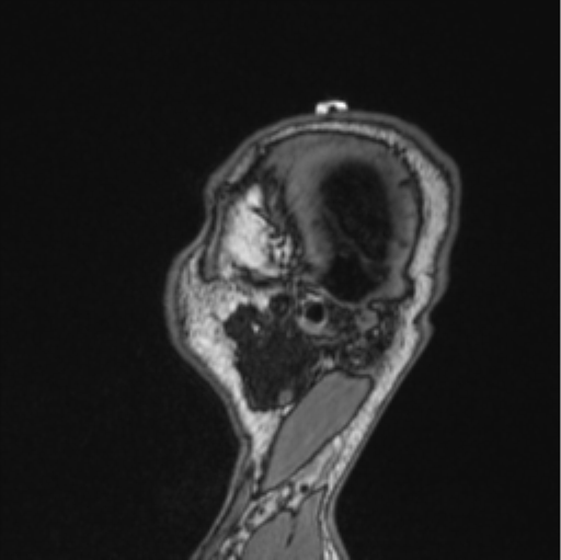 File:Cerebellar hemangioblastomas and pituitary adenoma (Radiopaedia 85490-101176 Sagittal T1 21).png