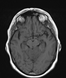 File:Cerebellar metastasis (Radiopaedia 54578-60810 Axial T1 16).png