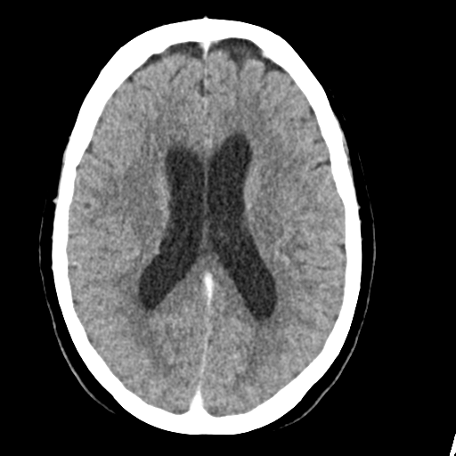 Cerebellar metastasis (Radiopaedia 54578-60812 Axial C+ 29).png