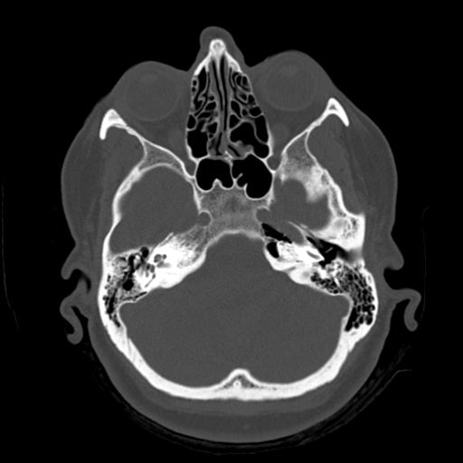 Cerebellar metastasis (cystic appearance) (Radiopaedia 41395-44258 Axial bone window 14).png