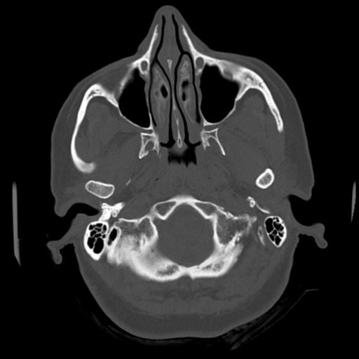 Cerebellar metastasis (cystic appearance) (Radiopaedia 41395-44258 Axial bone window 6).png