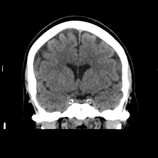 Cerebellar metastasis (cystic appearance) (Radiopaedia 41395-44258 Coronal non-contrast 27).png
