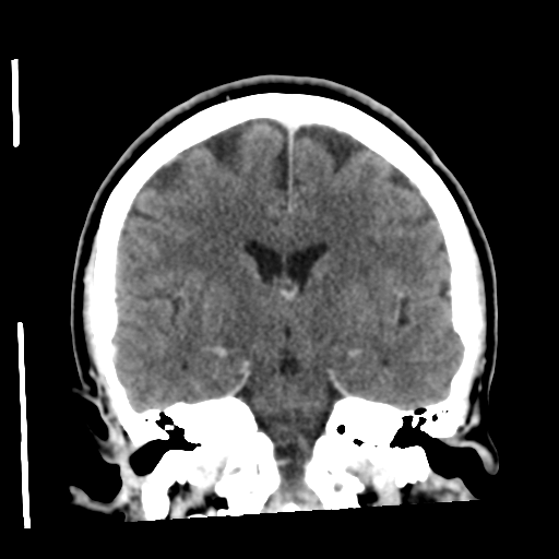 Cerebellar metastasis (cystic appearance) (Radiopaedia 41395-44258 D 33).png