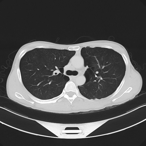 Cerebellar metastasis - adenocarcinoma lung (Radiopaedia 63184-71717 Axial lung window 26).png