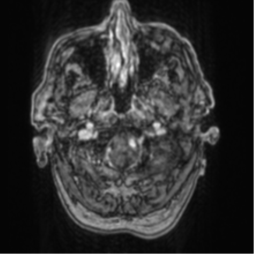 Cerebellar metastasis from lung adenocarcinoma (Radiopaedia 86690-102829 Axial T1 C+ 11).png