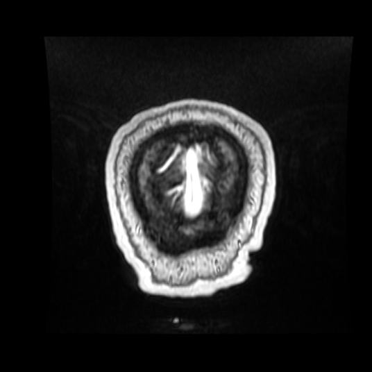 Cerebellar metastasis of pulmonary adenocarcinoma, cavernous venous malformation, and developmental venous anomaly (Radiopaedia 85827-101661 Coronal T1 C+ 13).jpg