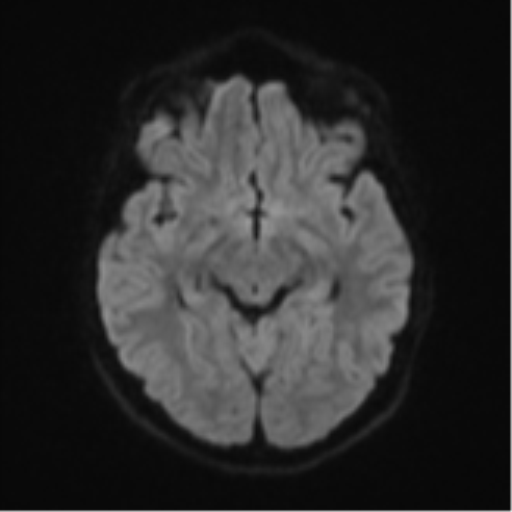Cerebellar tuberculomas (Radiopaedia 46939-51472 Axial DWI 41).png