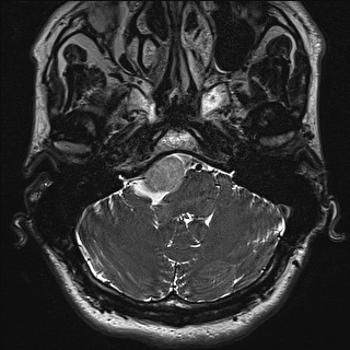 File:Cerebellopontine angle meningioma (Radiopaedia 72983-83680 Axial FIESTA 13).jpg