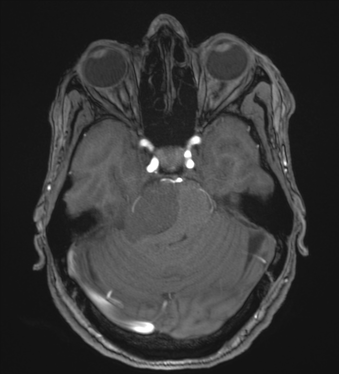 Cerebellopontine angle meningioma (Radiopaedia 72983-83680 Axial MRA 37).jpg