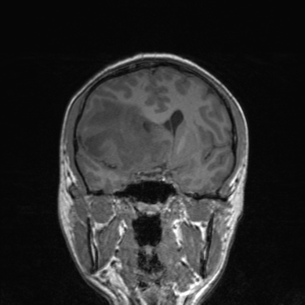 File:Cerebral abscess (Radiopaedia 24212-24478 Coronal T1 93).jpg