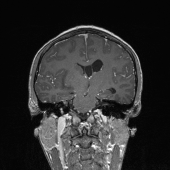 Cerebral abscess (Radiopaedia 24212-24478 Coronal T1 C+ 116).jpg