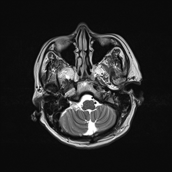 Cerebral abscess (Radiopaedia 26111-26247 Axial T2 15).jpg