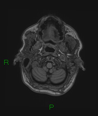 Cerebral abscess and subdural empyema (Radiopaedia 84436-99779 Axial T1 78).jpg