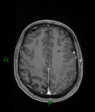 Cerebral abscess and subdural empyema (Radiopaedia 84436-99779 Axial T1 C+ 27).jpg