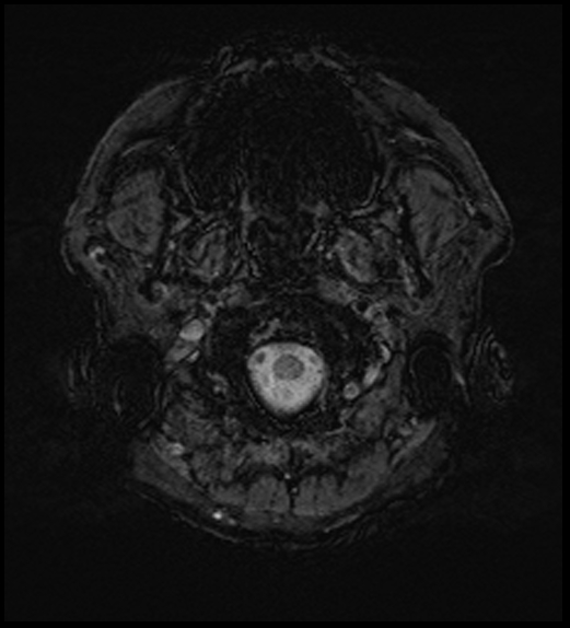 Cerebral abscess with ventriculitis (Radiopaedia 78965-91878 Axial SWI 4).jpg