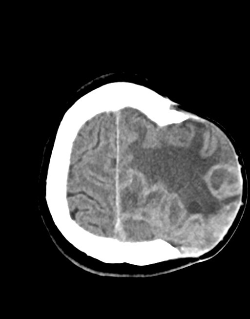 Cerebral abscesses (Radiopaedia 70458-80568 Axial non-contrast 51).jpg