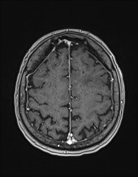 Cerebral amyloid angiopathy-related inflammation (Radiopaedia 58270-65377 Axial T1 C+ fat sat 112).jpg