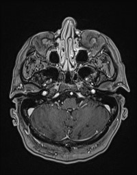 Cerebral amyloid angiopathy-related inflammation (Radiopaedia 58270-65377 Axial T1 C+ fat sat 20).jpg