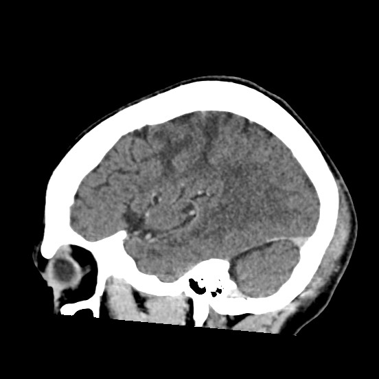 Cerebral amyloid angiopathy-related inflammation (Radiopaedia 74836-85848 C 46).jpg