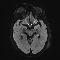 Cerebral amyloid angiopathy-related inflammation (Radiopaedia 74836-85849 Axial DWI 43).jpg