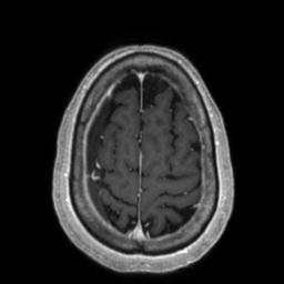 Cerebral amyloid angiopathy (Radiopaedia 29129-29518 Axial T1 C+ 126).jpg