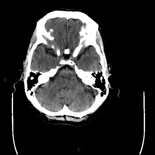 Cerebral amyloid angiopathy (Radiopaedia 77506-89665 Axial non-contrast 27).jpg