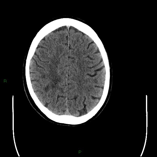Cerebral amyloid angiopathy (Radiopaedia 77506-89665 Axial non-contrast 79).jpg