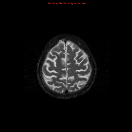 File:Cerebral and orbital tuberculomas (Radiopaedia 13308-13311 Axial T2 18).jpg