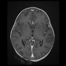 Cerebral and spinal tuberculosis (Radiopaedia 90489-107837 Axial T1 C+ 101).jpg