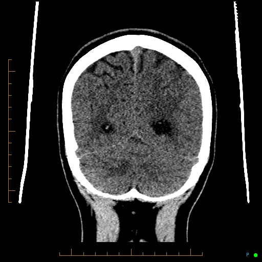 Cerebral arteriovenous malformation (AVM) (Radiopaedia 78162-90706 Coronal non-contrast 77).jpg