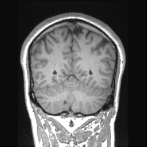 Cerebral arteriovenous malformation (Radiopaedia 39259-41506 Coronal T1 27).png