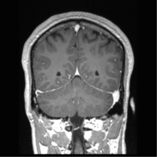 Cerebral arteriovenous malformation (Radiopaedia 39259-41506 Coronal T1 C+ 29).png