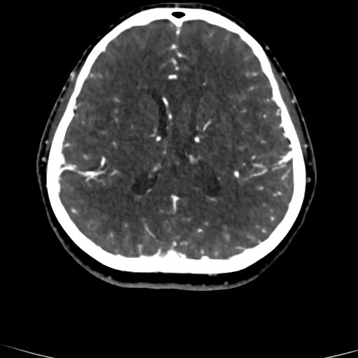 Cerebral arteriovenous malformation (Radiopaedia 73830-84645 Axial C+ delayed 38).jpg