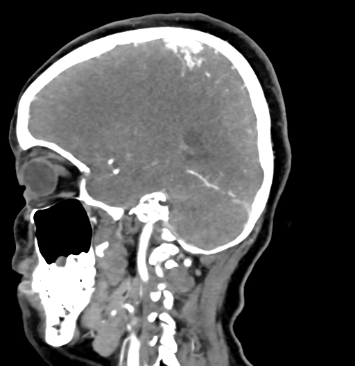 Cerebral arteriovenous malformation (Radiopaedia 73830-84645 D 63).jpg