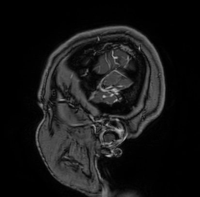 Cerebral arteriovenous malformation (Radiopaedia 74411-85654 Sagittal T1 C+ 5).jpg