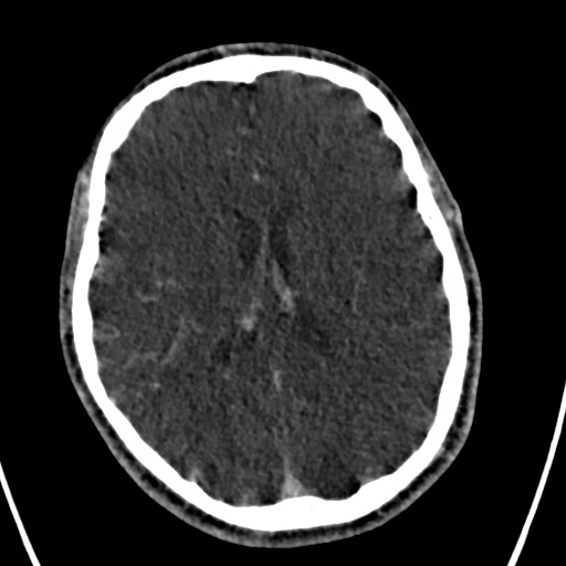 Cerebral arteriovenous malformation (Radiopaedia 78188-90746 Axial C+ delayed 104).jpg