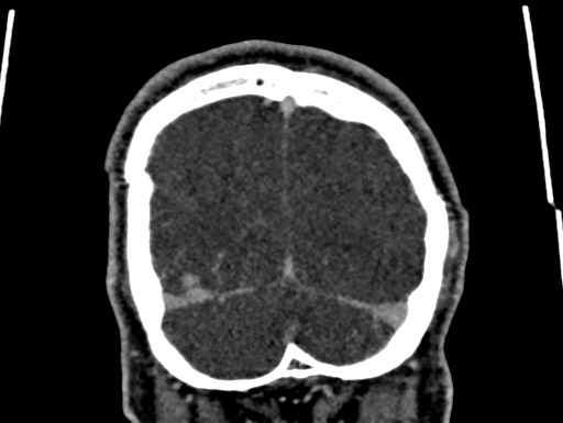 Cerebral arteriovenous malformation (Radiopaedia 78188-90746 Coronal C+ delayed 112).jpg