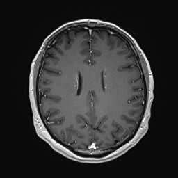 Cerebral arteriovenous malformation (Radiopaedia 84015-99245 Axial T1 C+ 100).jpg