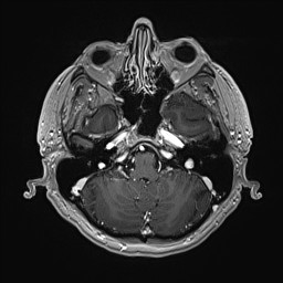 Cerebral arteriovenous malformation (Radiopaedia 84015-99245 Axial T1 C+ 40).jpg