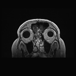 Cerebral arteriovenous malformation (Radiopaedia 84015-99245 Coronal T1 C+ 22).jpg